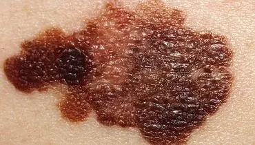 عوامل دخیل در بروز آکنه و جوش صورت