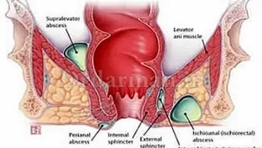درمان و جراحی بیماری آبسه مقعد به وسیله لیزر