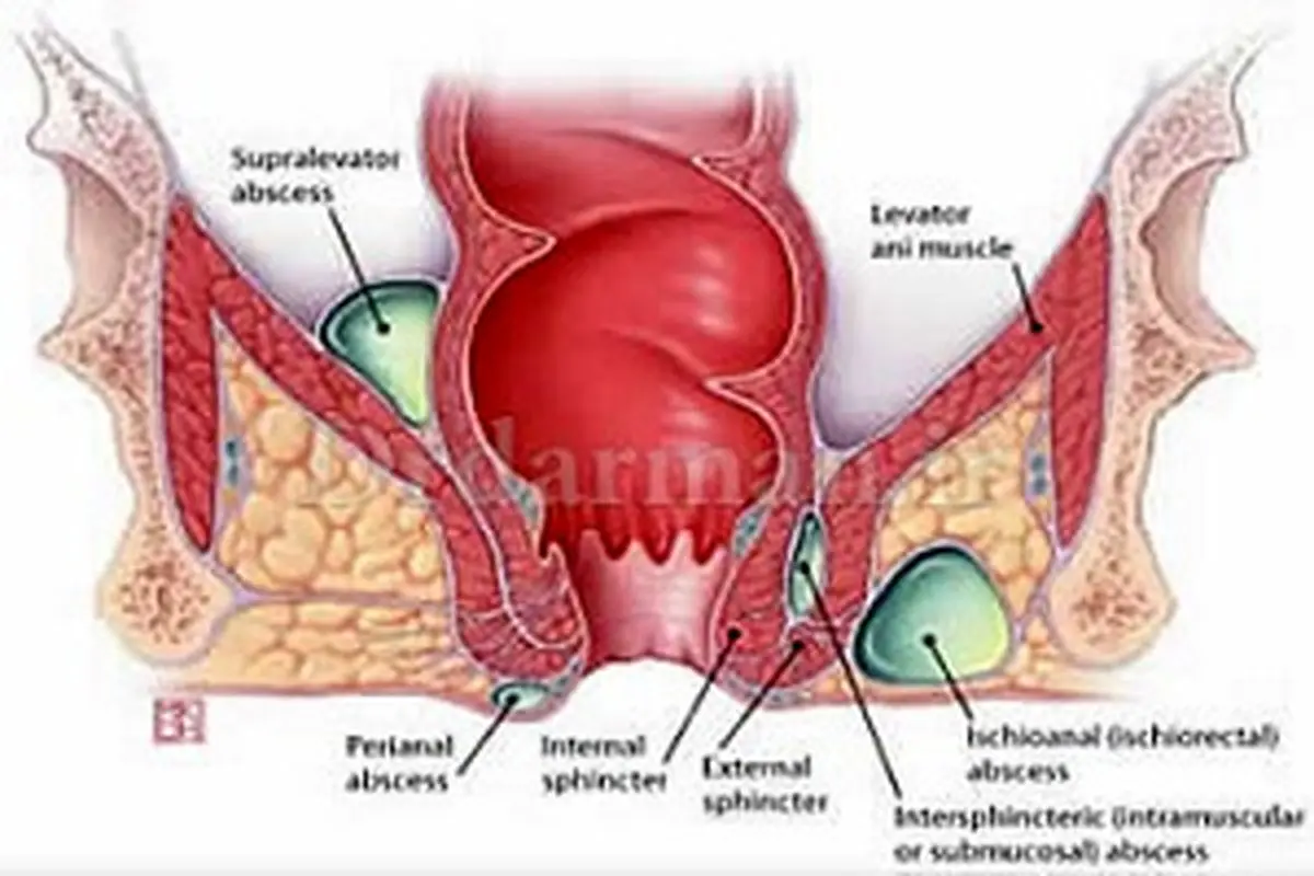درمان و جراحی بیماری آبسه مقعد به وسیله لیزر