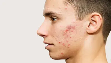 علل بوجود آمدن آکنه  و روش های موثر در پیشگیری از آن