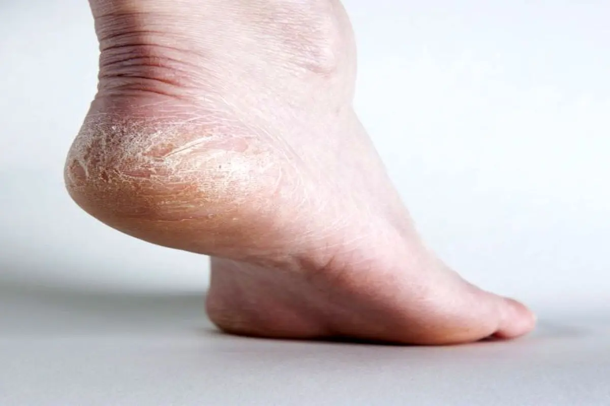 تاثیر سنگ پا در درمان خشکی پا