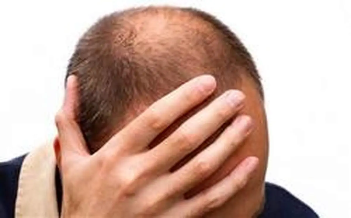 چرا کاهش وزن موجب ریزش مو میشود؟