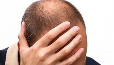 چرا کاهش وزن موجب ریزش مو می‌شود؟