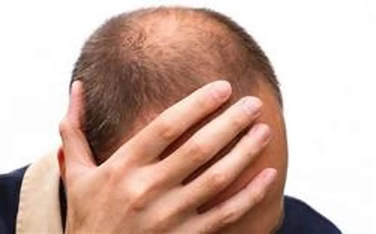 چرا کاهش وزن موجب ریزش مو می‌شود؟