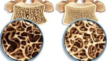 ارتباط پوکی استخوان و تراشه های ناخن
