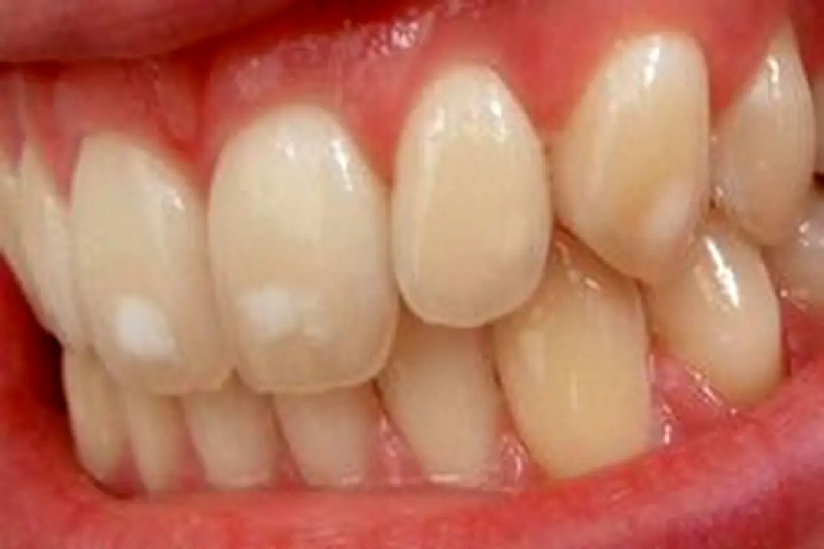 دلیل لکه های سفید روی دندان چیست