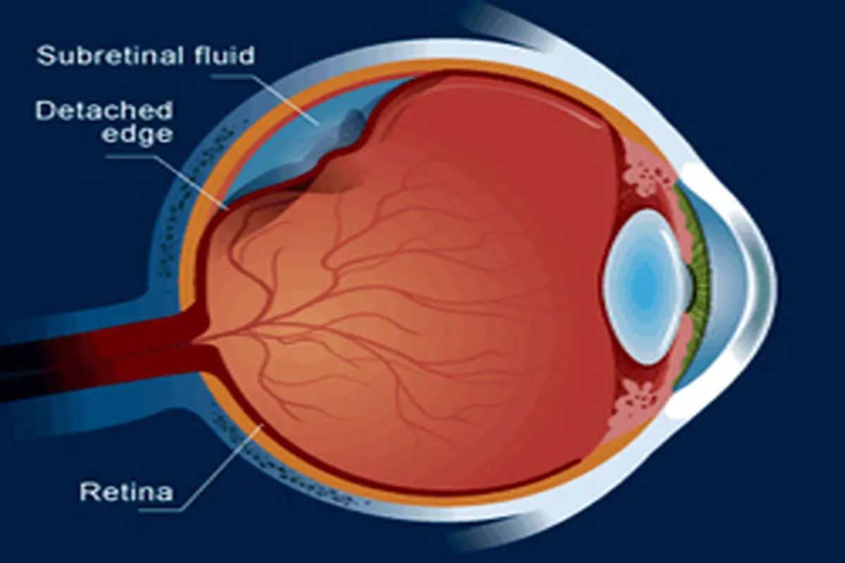 درمان جدا شدگی پرده شبکیه چشم