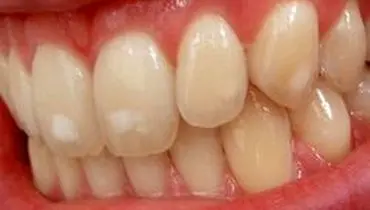 جرم گیری نامناسب دندان باعث بیماری لثه می شود.