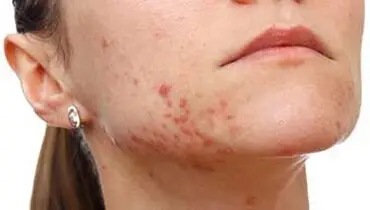 10 روش طبیعی برای از بین بردن جای جوش