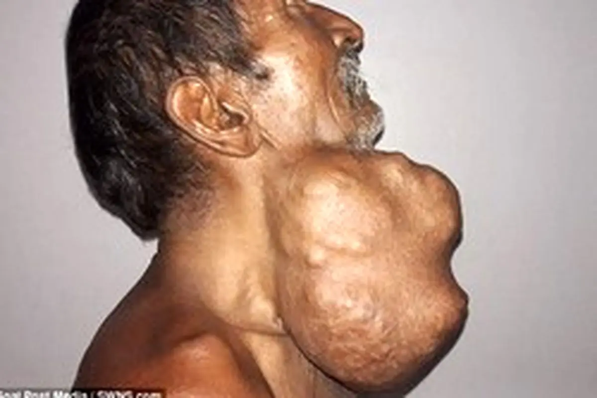 جراحی تومور عجیب در گردن مرد هندی