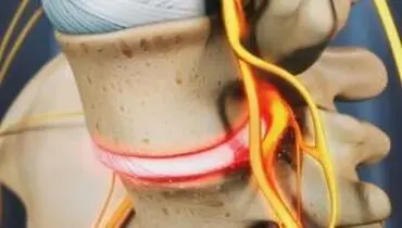 دویدن از درد دیسک کمر جلوگیری می‌کند