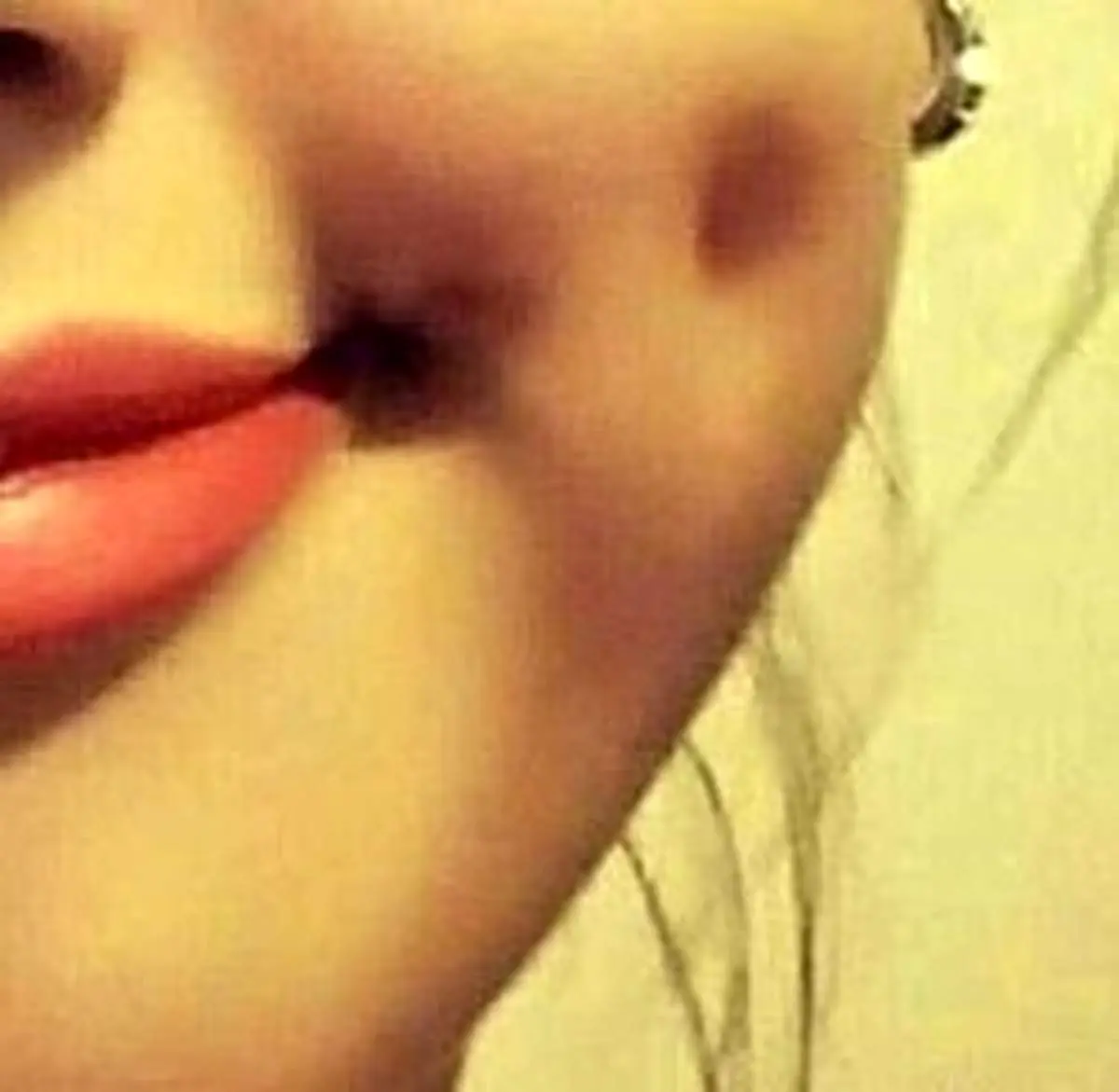 ایجاد چال گونه به روش طبیعی