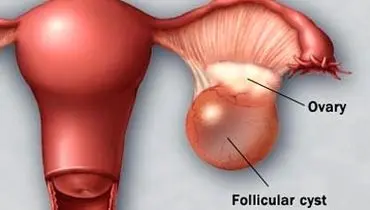 درمان سندرم تخمدان پُلی‌کیستیک از طریق طب سنتی