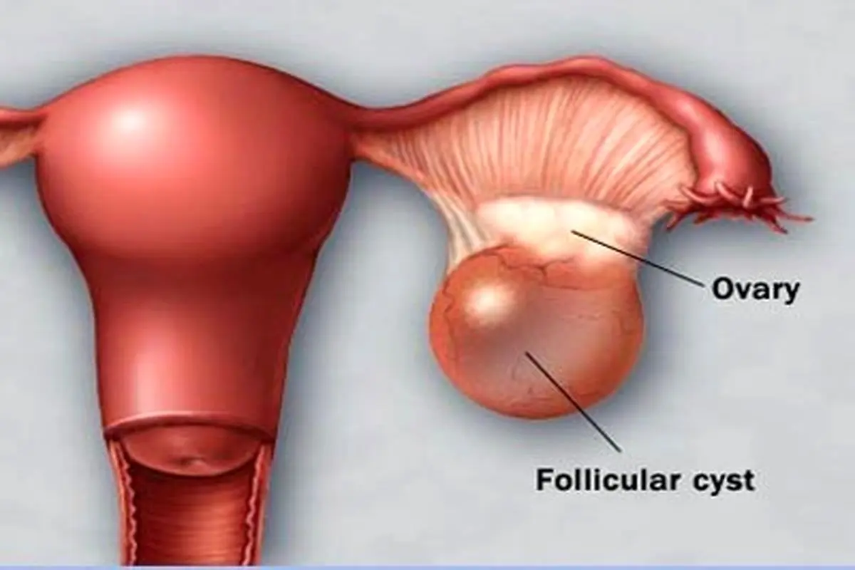 درمان سندرم تخمدان پُلی‌کیستیک از طریق طب سنتی