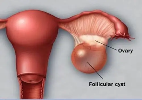 چرا سندرم تخمدان پلی‌کیستیک (PCOS) در بسیاری از خانواده‌ها نسل به نسل تکرار می‌شود؟