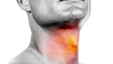 سرطان سر و گردن و میزان شیوع آن در مردان
