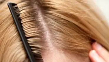 درمان های خانگی برای موهای چرب