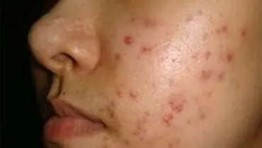 جوش را چگونه درمان کنیم