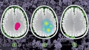 درمان سرطان با قرار دادن نانو ذرات در بدن