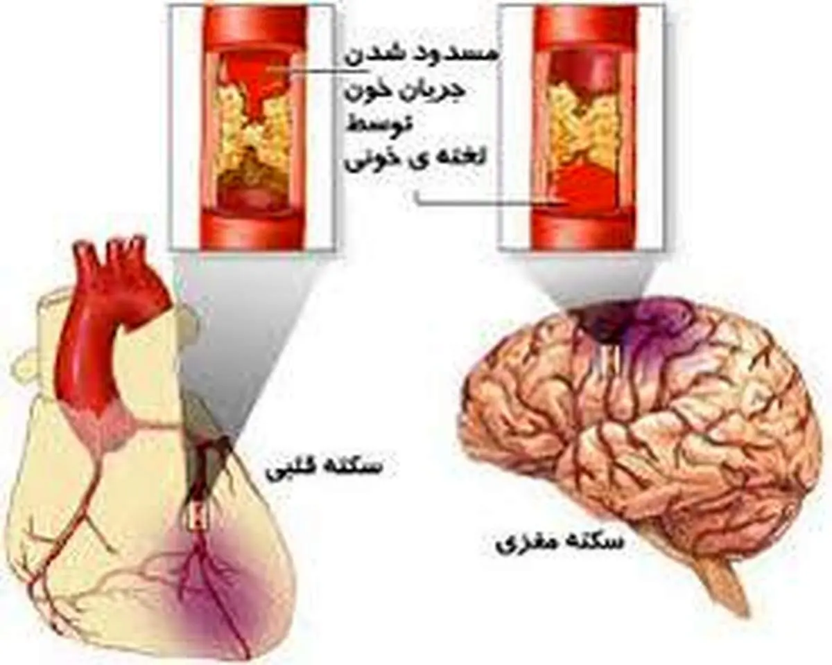 درمان رایگان سکته های قلبی و مغزی