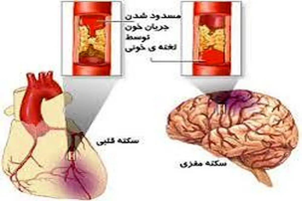 درمان رایگان سکته‌ های قلبی و مغزی