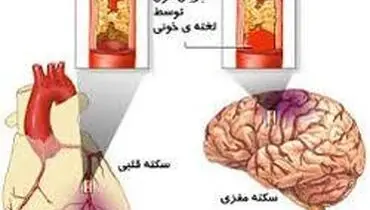 درمان رایگان سکته‌ های قلبی و مغزی