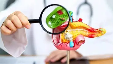 برای جلوگیری از سنگ کیسه صفرا چی بخوریم؟

