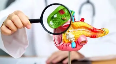 برای جلوگیری از سنگ کیسه صفرا چی بخوریم؟

