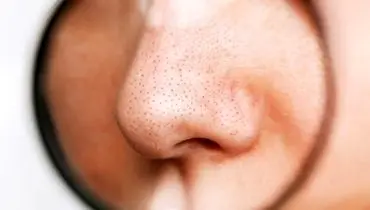 چگونه منافذ باز بینی را  با روش‌های خانگی از بین ببریم؟