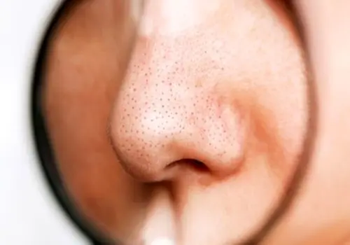 چگونه منافذ باز بینی را  با روش‌های خانگی از بین ببریم؟