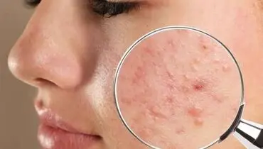 معرفی ۵ روش کاربردی جلوگیری از جوش‌ زدن بعد از بند انداختن صورت