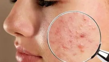 معرفی ۵ روش کاربردی جلوگیری از جوش‌ زدن بعد از بند انداختن صورت
