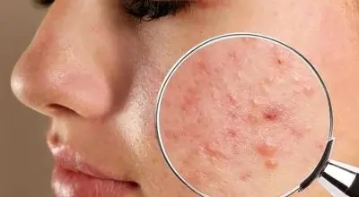 معرفی ۵ روش کاربردی جلوگیری از جوش‌ زدن بعد از بند انداختن صورت