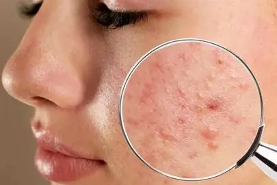 معرفی ۵ روش کاربردی جلوگیری از جوش‌ زدن بعد از بند انداختن صورت