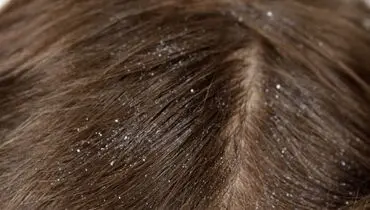 چند راهکار ساده برای از بین بردن شوره سر
