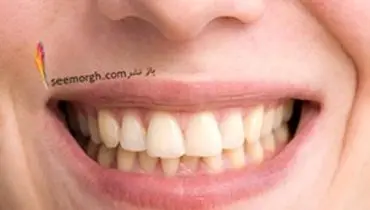 زرد شدن دندان‌ها بر اثر این ۶ عادت غلط