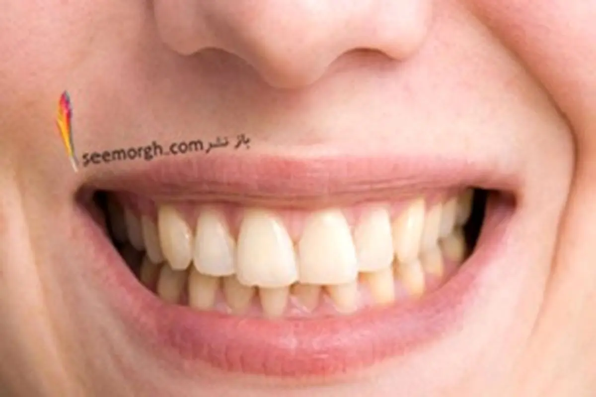 زرد شدن دندان‌ها بر اثر این ۶ عادت غلط
