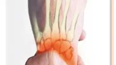 
آرتروز و تغذيه مناسب