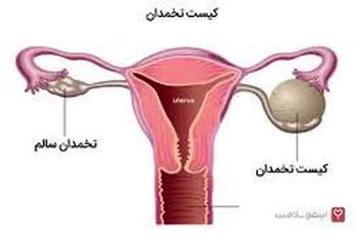 نکاتی درباره «کیست های تخمدان»