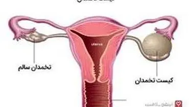 نکاتی درباره  «کیست های تخمدان»