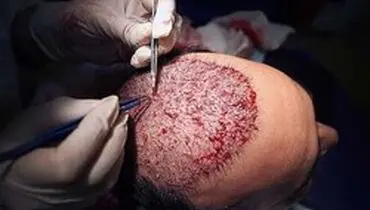 با عوارض کاشت مو آشنا شوید