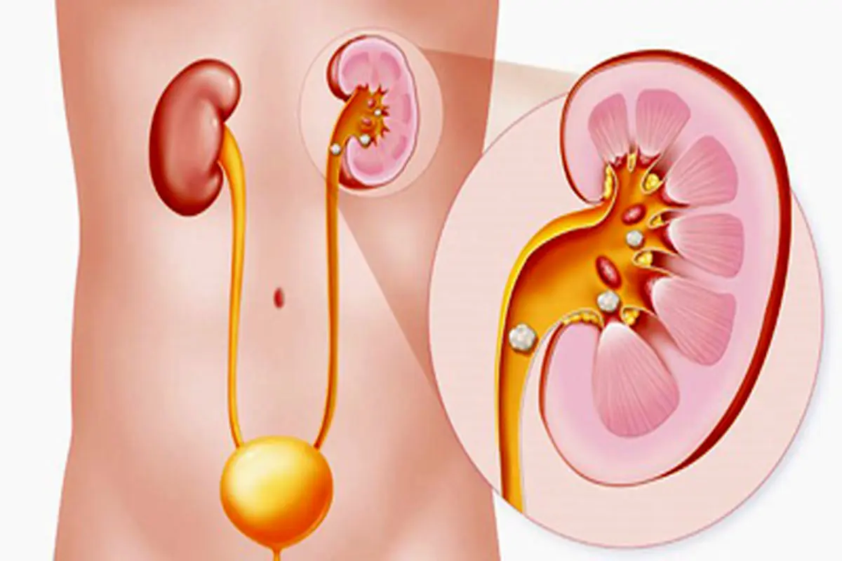 ۱۰ عاملی که تصور نمی‌کنید عامل ابتلا به سنگ کلیه باشند