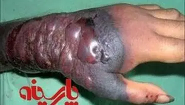 افزایش شمار قربانیان ابولا در کنگو به ۷۵ نفر