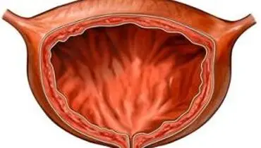 سایر اقدامات برای مقابله با التهاب مثانه