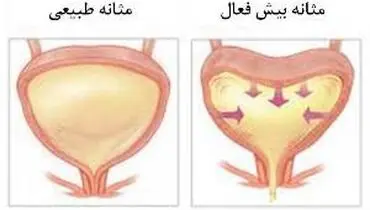 علائم مثانه بیش فعال کدام‌ها هستند؟