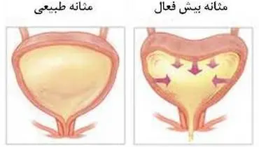 علائم مثانه بیش فعال کدام‌ها هستند؟