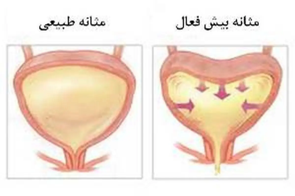 علائم مثانه بیش فعال کدام‌ها هستند؟