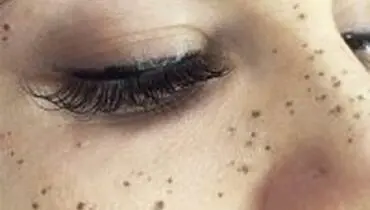 چرا دختران ایرانی، روی صورت‌شان کک مک تتو می‌کنند؟