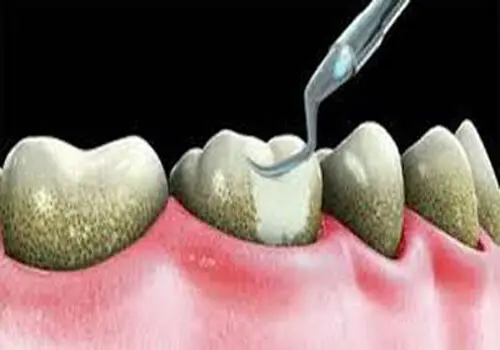 نسخه طب سنتی برای جرم گیری دندان در خانه