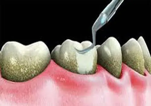 نسخه طب سنتی برای جرم گیری دندان در خانه